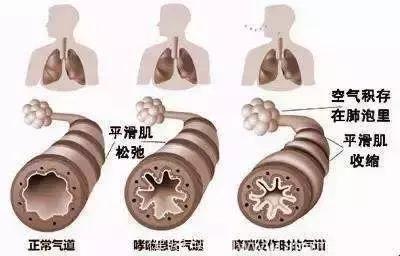 世界防治哮喘日控制哮喘，刻不容缓！