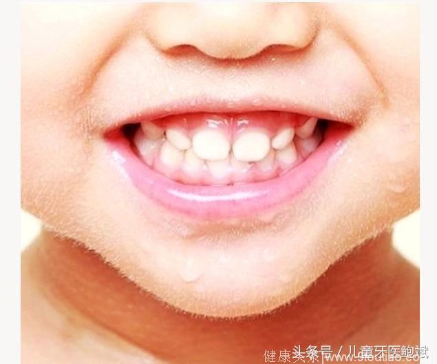 鲍斌无忧看牙25期-宝宝牙齿黑，宝宝心里苦啊