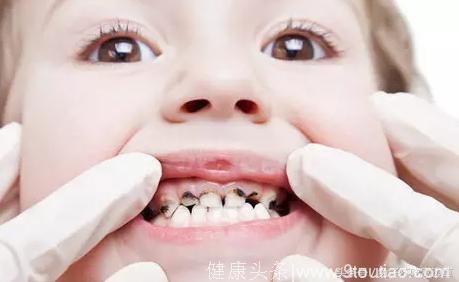 宝宝：乳牙为何容易患龋齿呢？
