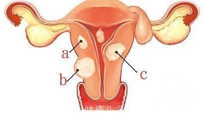 子宫肌瘤类型有哪些？如何诊断治疗？