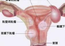 女性肥胖“子宫肌瘤”发病率高
