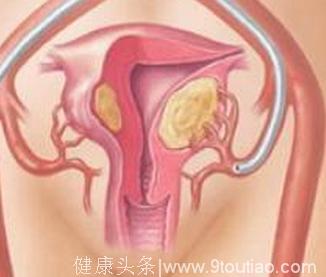 子宫肌瘤是怎么来的子宫肌瘤的治疗方法