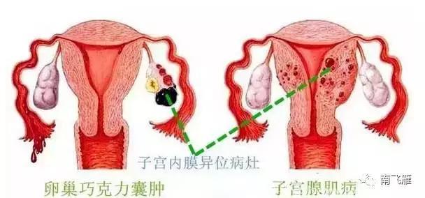 痛经！警惕子宫内膜异位症