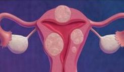 了解子宫肌瘤为什么会引起不孕