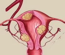 了解子宫肌瘤为什么会引起不孕
