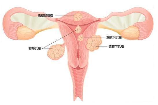 子宫肌瘤是女性健康的“杀手”！怎样判断是否患子宫肌瘤？