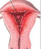 慢性子宫内膜炎的典型症状表现