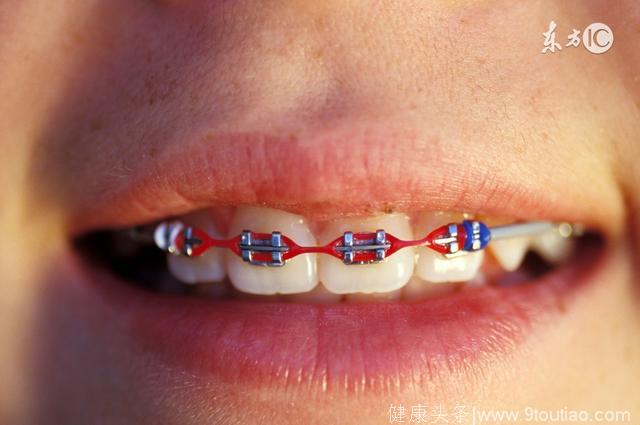 牙齿矫正 不仅仅为了整齐那么简单，也无需等到儿童乳牙全部替换完毕