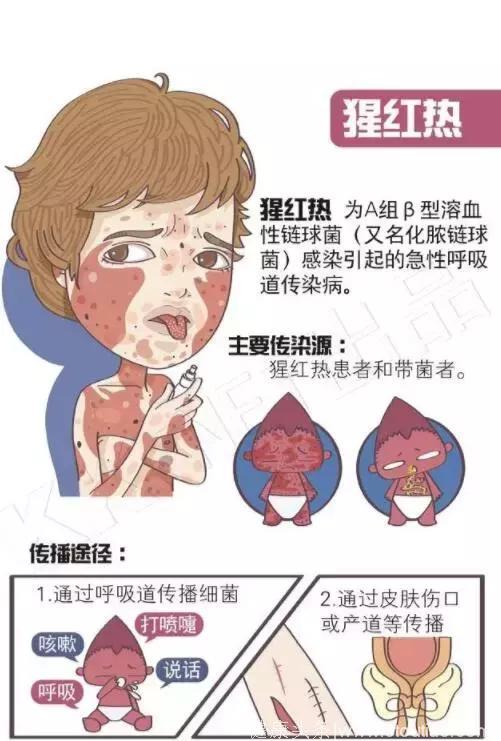 山东猩红热进入高发季，青岛2~8岁的儿童要小心！怎么预防看这里