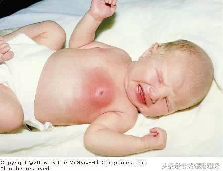 宝宝出生后两三天，挤乳房，不挤会痒痒？权威给你答案