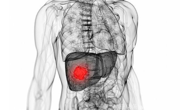 肝癌容易向这个部位转移！出现这种情况赶紧上医院