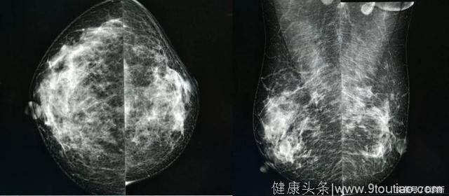 乳腺钼靶报告相关规范