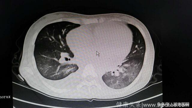 女大学生反复高烧下肢水肿，心脏被细菌“吞噬”！竟因一场感冒？