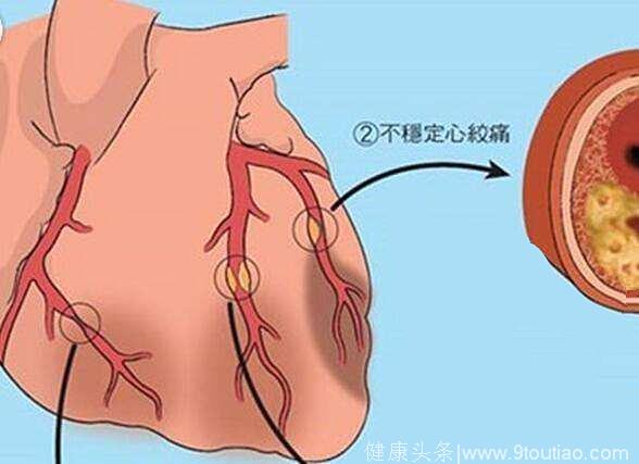 心绞痛在某种程度上确实“与众不同”