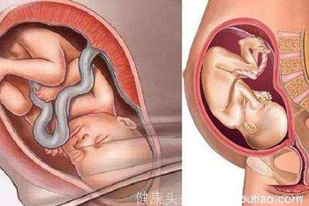 关于胎儿入盆是什么感觉 五大征兆你一定要知晓