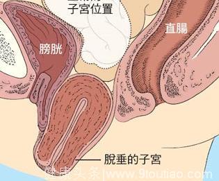 如何治疗子宫脱垂有特效呢