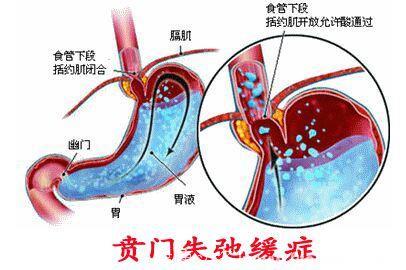 男子这块肌肉出了问题！一吃饭就想吐折磨5年，食管还失去蠕动力！