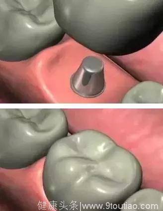 北大口腔种植牙手术全过程，重见满口新牙
