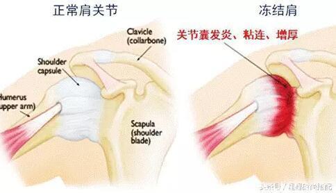 肩周炎治不好四处求药？盐炒小茴香，一治一个好！赶紧帮家人存起来！