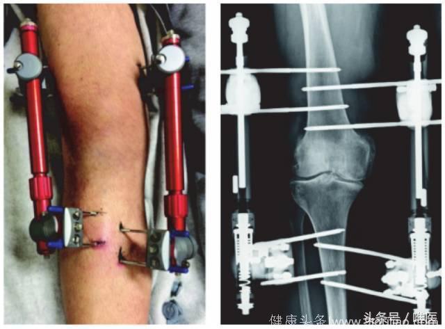 骨科前沿｜膝关节炎患者：全膝关节置换术较牵伸治疗效果更佳！