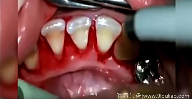 30年的老牙结石撑着满口牙，洗完之后齿缝就可以塞进一颗牙齿
