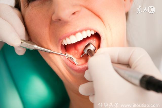 30年的老牙结石撑着满口牙，洗完之后齿缝就可以塞进一颗牙齿
