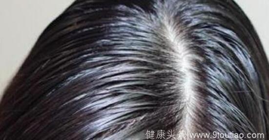 怎样区分脂溢性脱发和雄性激素脱发