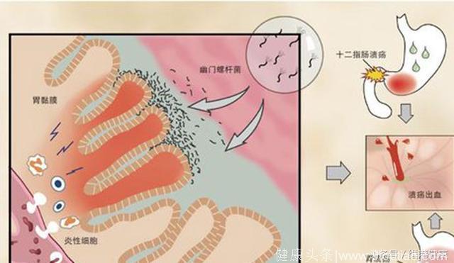 与胃癌相关的细菌幽门螺杆菌研究发现
