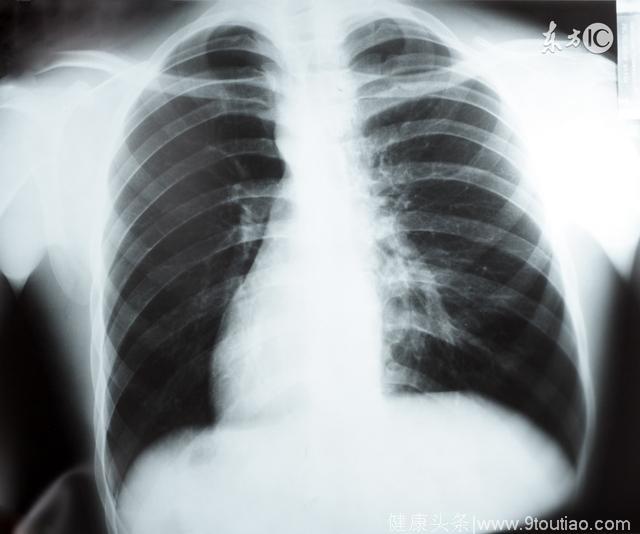 很多人的困惑：CT发现肺结节该怎么办？