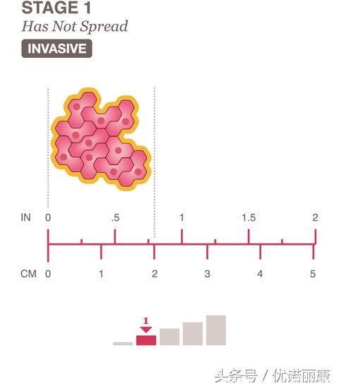 不懂乳腺癌分期？本文为您详解乳腺癌的5个分期