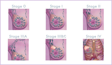 不懂乳腺癌分期？本文为您详解乳腺癌的5个分期