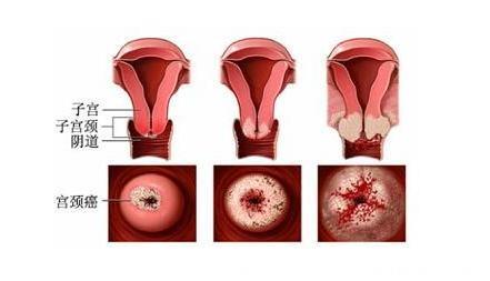 身体出现这4种症状别忽视，它们是宫颈癌来临征兆！