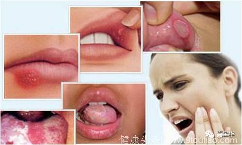 口腔溃疡真的是缺乏维生素？你可能忽略了这些原因！