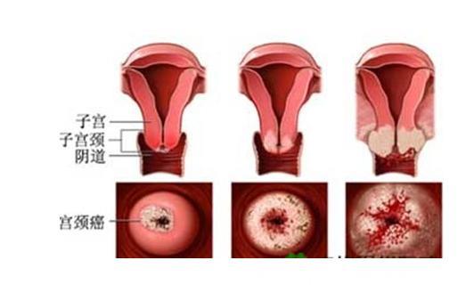 “医生告诫：有这3种经历的女性，最好查查宫颈癌，能救命”