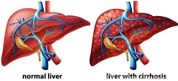 当你发现这5个症状时，可能肝脏出问题，小心是肿瘤！