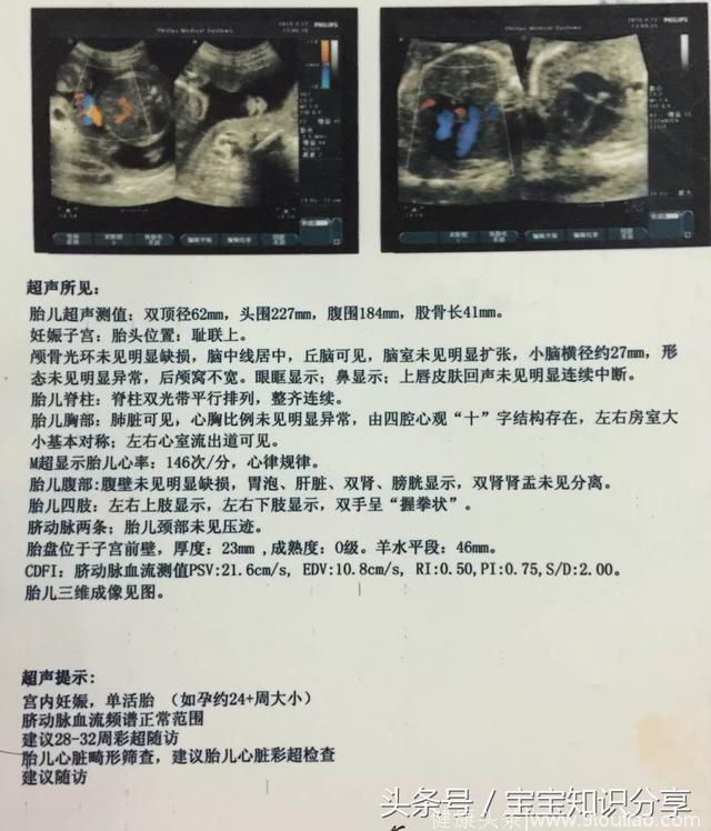 二胎顺产男宝 女儿几件事温暖了产房所有人 分享孕期检查 生产经验