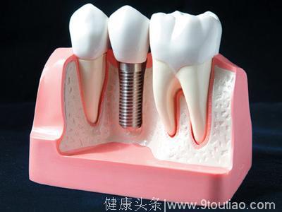 牙医短科普丨什么样的人能种牙