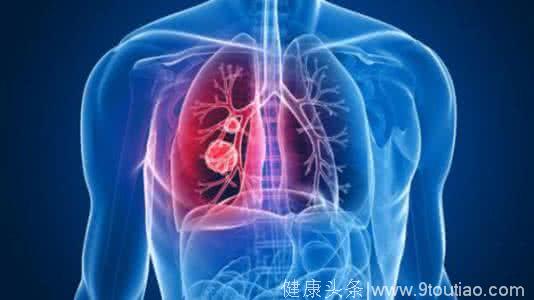 小心这些肺病可能转成癌 肺癌发生有何原因？