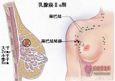 乳腺癌，临床可治愈的癌