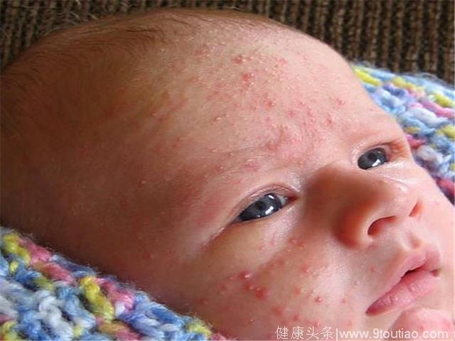 一名儿童湿疹亲测 一个农村的方法，能治愈湿疹不再复发