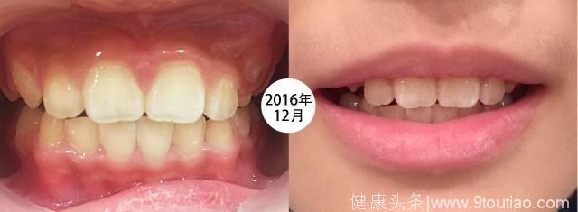 牙齿矫正要从3岁+开始？因为成人整牙又贵又疼，孩子整牙能改脸型！