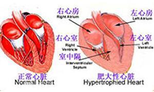 心肌病原来分为这么多类，中医如何看待？生活中注意哪些？