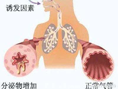 支气管哮喘用药的4大误区