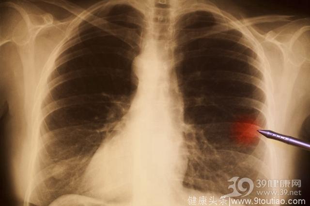 肺癌有4个不典型症状，你可能就是错过它的！