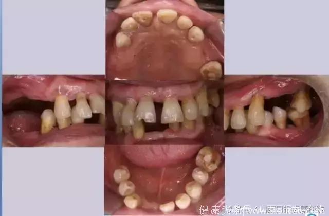 你的牙越来越松，知道原因吗？