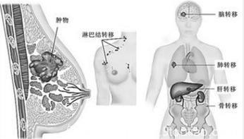 乳腺癌需理性对待 浸润性乳腺癌和非浸润性乳腺癌