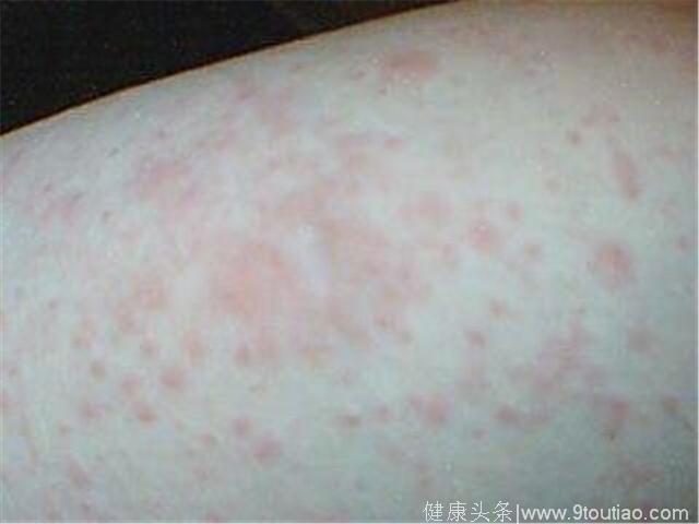 湿疹“瘙痒难耐”？生活中的两个食疗方法，1个月赶走湿疹