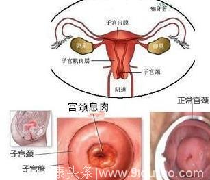 什么是子宫息肉与子宫肌瘤的区别有哪些