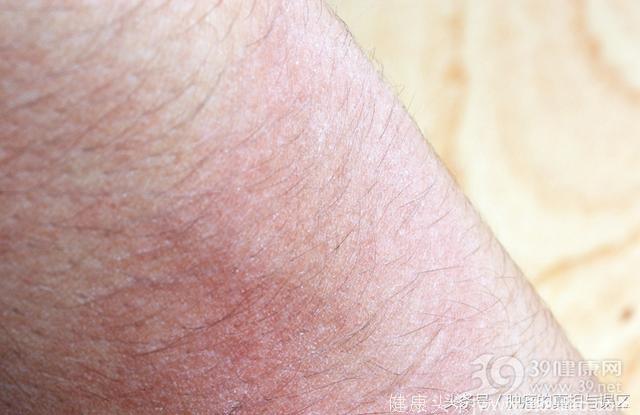 注意：皮肤上出现这几种症状，可能是癌症信号！