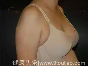 什么是副乳？副乳的危害有那些？